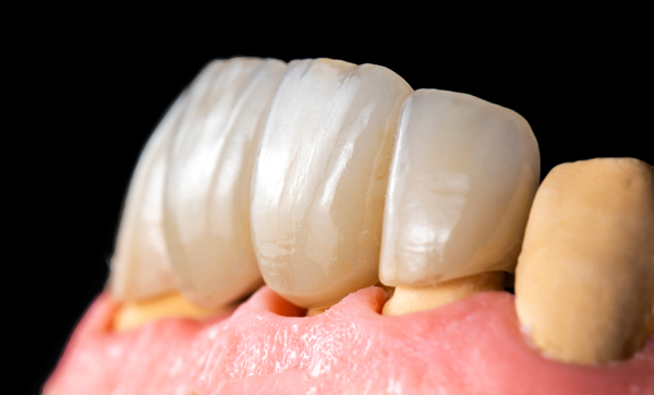 How Are Veneers Used In Cosmetic Dentistry?