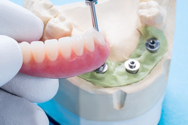 Major Benefits Of Implant Supported Dentures Over Traditional Options